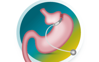 Removal with Sleeve Gastrectomy