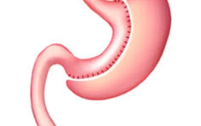 gastric sleeve surgery
