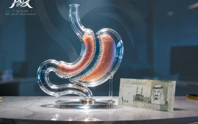 سعر عملية التكميم والعوامل المؤثرة فيه