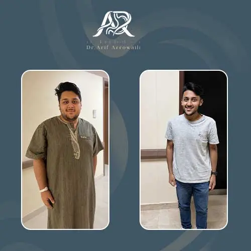 تكميم المعدة قبل وبعد